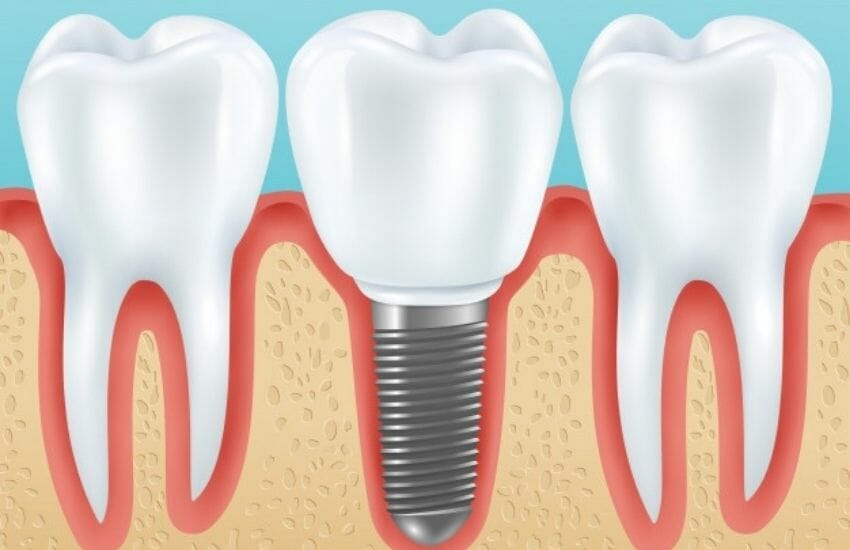Dental implant results