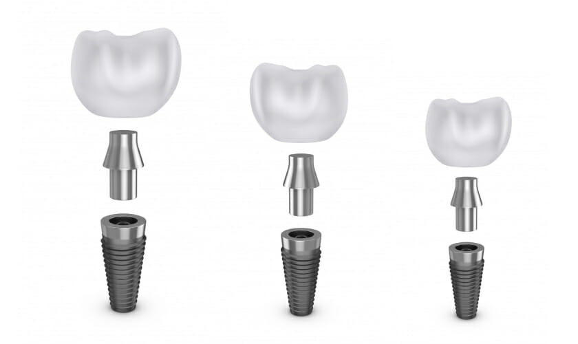 dental-implant