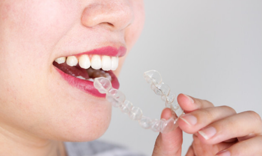 Invisalign Treatment - Dentist in Dallas TX 75219