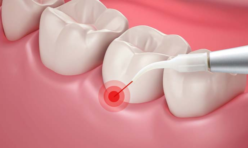 gum laser treatment