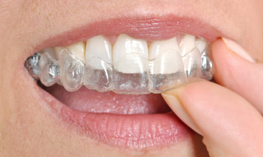 Invisalign treatment