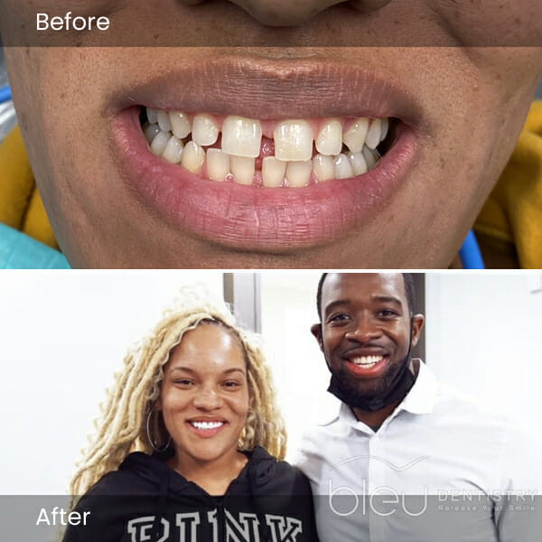 porcelain veneers