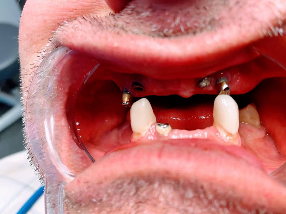 Implant Dentist Dallas