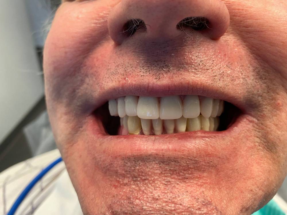 implants dentist in Dallas