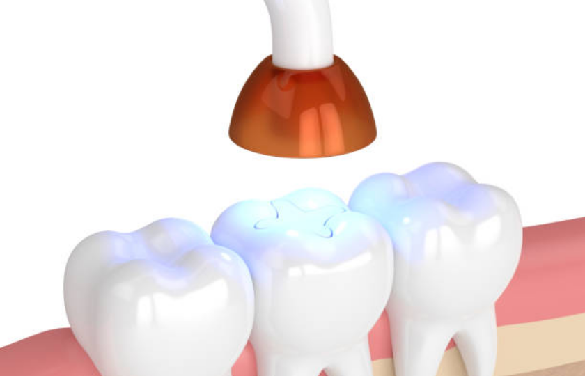 composite fillings Dallas