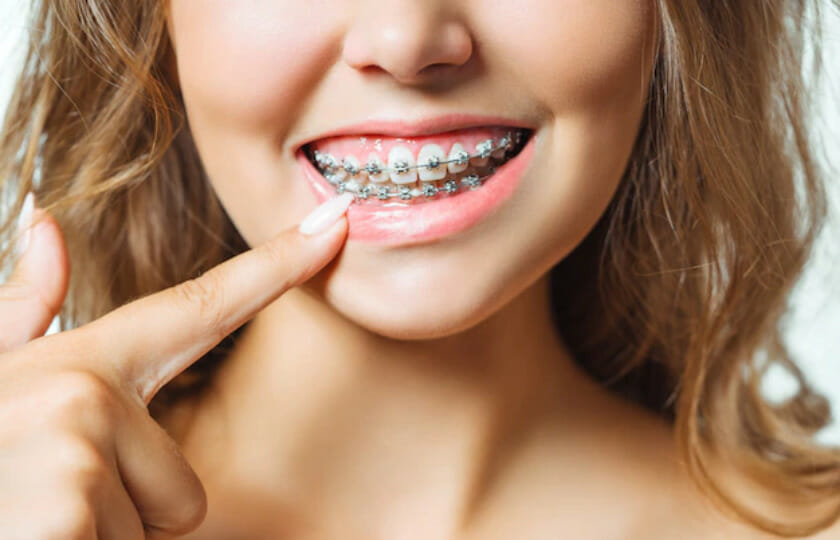 gums and braces